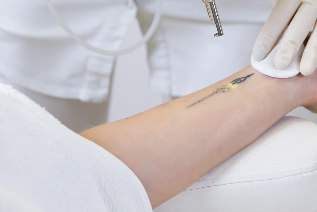 fjernelse af tatovering med laserbehandling
