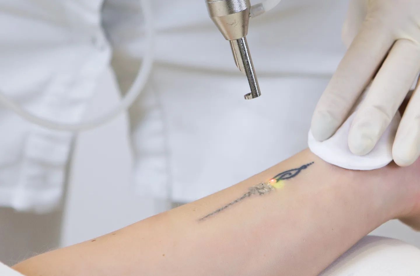 Fjernelse af tatovering i Køge nær Roskilde & Næstved